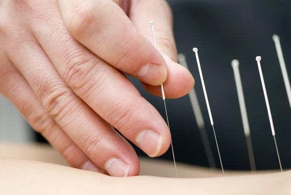 acupuncture